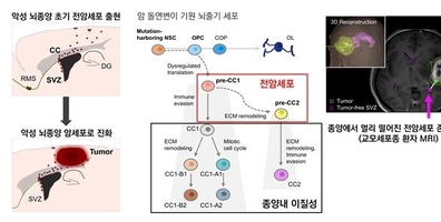 악성 뇌종양 '교모세포종' 되기 직전 단계 암세포 찾았다
